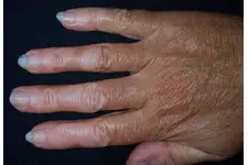 A Vitamini Eksikliğinde Görülen Hastalıklar Nelerdir?