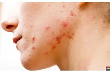 A Vitamini Sivilce Yapar mı? İyi Gelir mi?