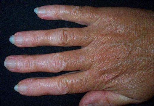 A Vitamini Eksikliğinde Görülen Hastalıklar Nelerdir?